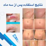 ژل سیلیکونی آنتی اسکار Kelo-Cote – پیشگیری و درمان جای زخم و اسکار با تکنولوژی پیشرفته سیلیکون